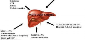 Main-Causes-Of-Liver-Damage-181237011506699