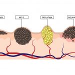 skin-cancer