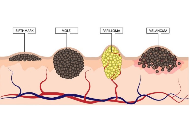 skin-cancer