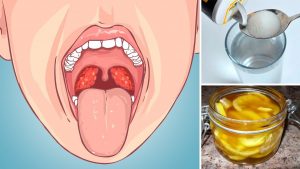 Home-Remedies-To-Cure-Strep-Throat1