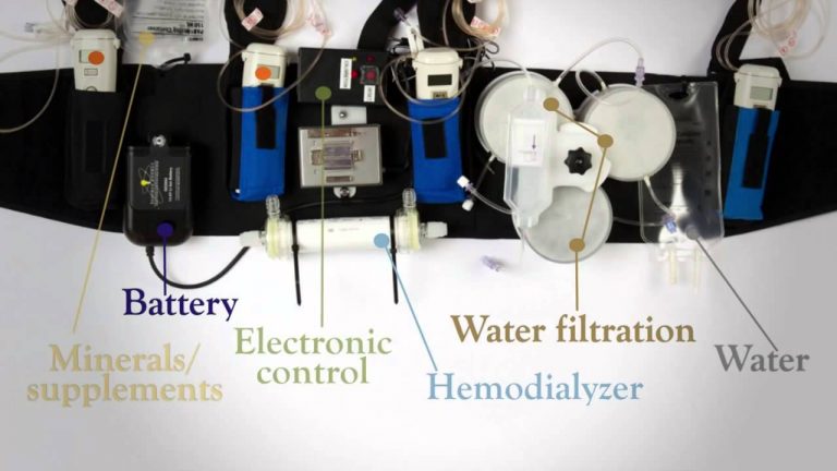 Wearable-Artificial-Kidney-May-Replace-Dialysis