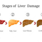 stages-liver-disease