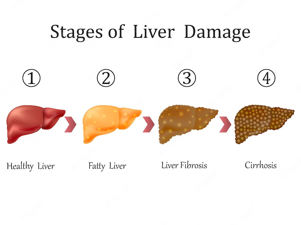 stages-liver-disease
