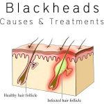 Tips-To-Remove-Blackhead-010104134784636