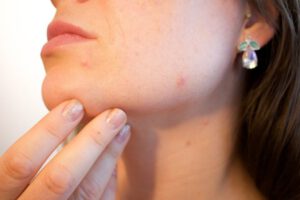 Skin-Acne-Skincare-Pimple-Pores-Face-Female-1606765-768x512