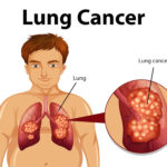 Lung Cancer Screening