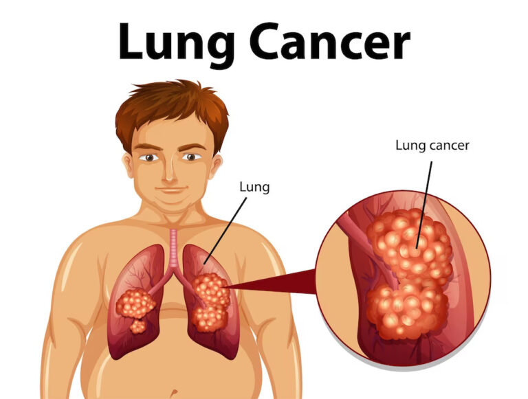 Lung Cancer Screening
