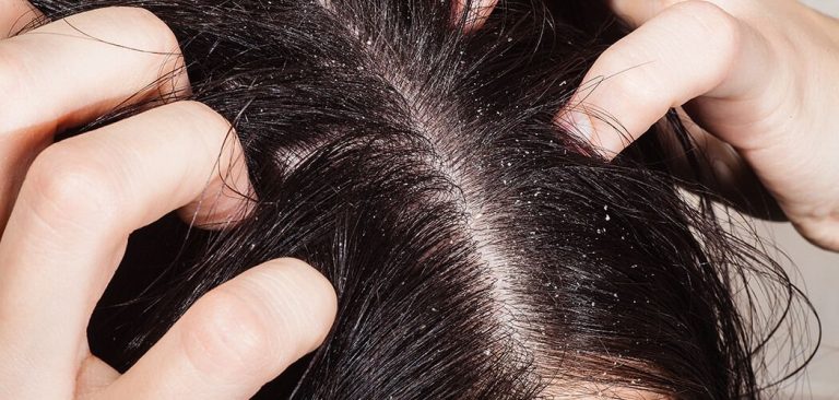 Dandruff