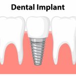 Dental-care