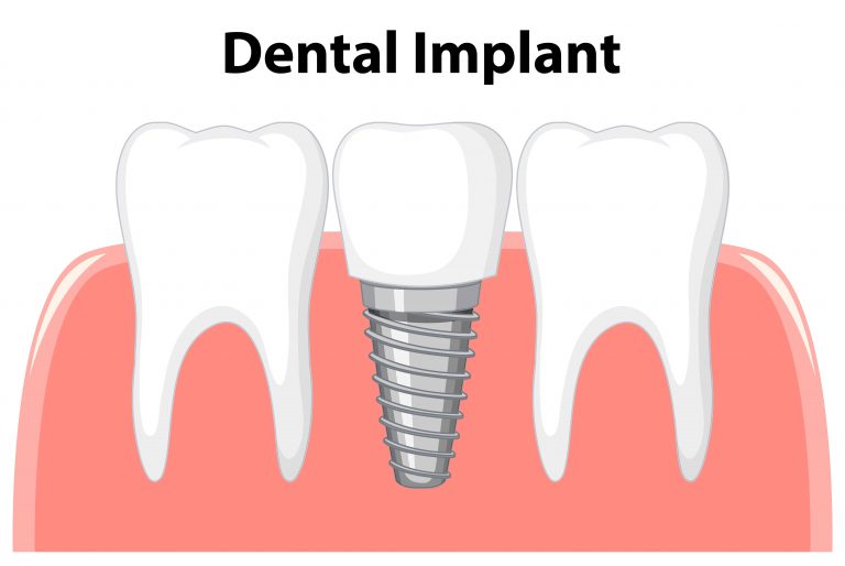 Dental-care