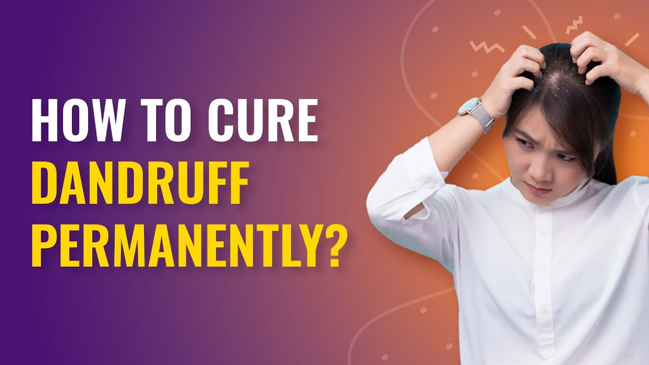 Cure-Dandruff-Permanently