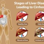 Liver-Cirrhosis