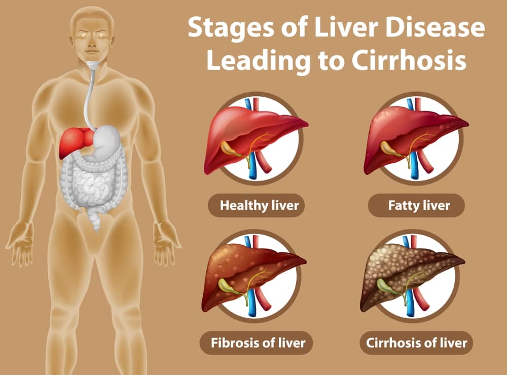 Liver-Cirrhosis