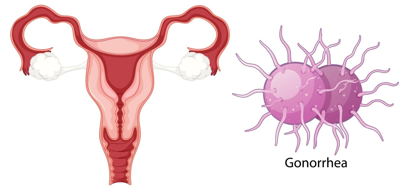 Symptoms Of Gonorrhea In Women